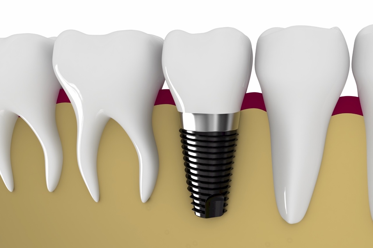 implantologia_cava_de_tirreni_sito_dentista-studio-dentistico-gigantino